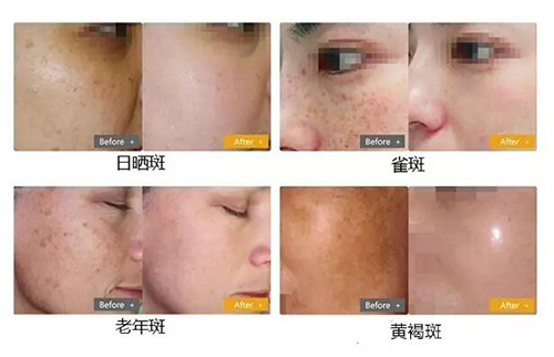 ��(w��n)�}Ƥ�w�K�Y(ji��)��&mdash;&mdash;��Ƥ�뼤��1064QVYH