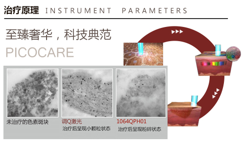 Ƥ�뼤��x��1064QPH01�_�����������¼oԪ